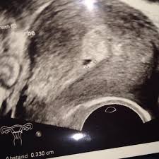Ich war bei 6+1 und mein arzt meinte er würde gerne embryo und dottersack sehen, für herzschlag könnte es ein paar tage zu früh sein. 7ssw Nur Fruchthohle Zu Sehen Gibt Es Noch Hoffnung Schwangerschaft Fehlgeburt