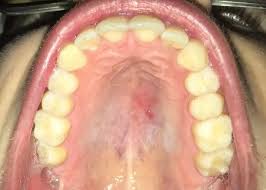 Image result for Mouth ulcers symptoms roof of the mouth
