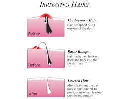 If it bothering you though, you can get rid of that bothersome ingrown hair bump with this easy method. Can Your Dermatologist Be The Answer To Your Ingrown Hair