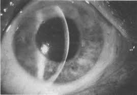 These symptoms usually go away within 3 to 5 days. Cataracts And Cataract Operations Second Of Two Parts Mayo Clinic Proceedings