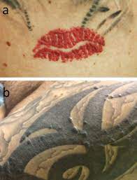 Tattoo Allergy Can We Identify The Allergen Sciencedirect