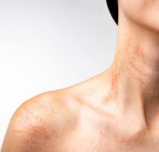 Image result for Hives