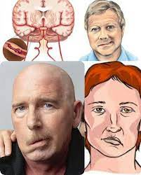 Obat stroke ringan sebelah kanan shddenature. Terbukti Obat Stroke Herbal Terbaik Penyakit Tanaman Obat Orang