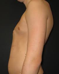 It's just the way your rib cage has formed. Pectus Posture Pectus Clinic