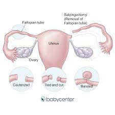 Sterilization can be done for women or men. Getting Your Tubes Tied Pros Cons What To Know Babycenter