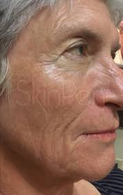 Skin Pen Microneedling in MN