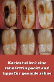 Wie sie zahnstein beim hund erkennnen, wie sie vorgehen sollten und warum zahnstein beim hund selbst entfenren keine 4.2. 32 Zahnstein Entfernen Ideen Zahnstein Entfernen Zahnstein Zahne