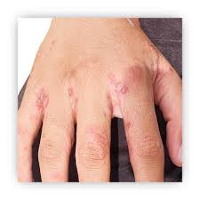 Image result for scabies on human skin