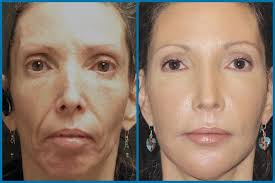Micro Needling Before And After Google Search Microneedling Skin Needling Serious Skin Care