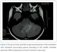 Image result for Brain Lesion