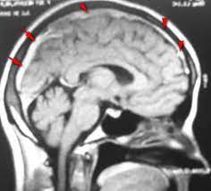 El factor v de leiden es un factor de riesgo genético para presentar una enfermedad. Trombosis De Los Senos Venosos Cerebrales Ecured