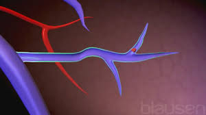 Come trattare l'embolia polmonare cause embolia polmonare i trattamenti sono differenti, in funzione della gravità dell'embolia. Embolia Polmonare Ep Disturbi Polmonari E Delle Vie Respiratorie Manuale Msd Versione Per I Pazienti