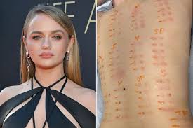 Joey King Shows Her Allergy Test Results in New Picture