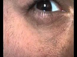 Et comment limiter la survenue de ces tremblements intempestifs? Oeil Qui Vibre Youtube