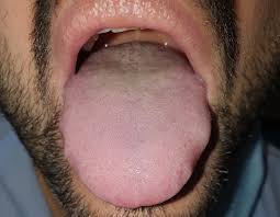 The enamel, especially at the cementoenamel junction (cej), undergoes large amounts of stress, causing micro fractures and tooth tissue loss. Covid Symptoms Spanish Study Describes Covid Tongue As Coronavirus Symptom Science Tech El Pais In English
