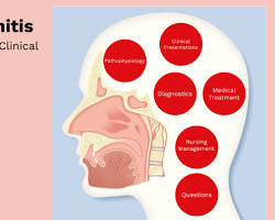 Image of Viral rhinitis symptoms