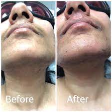 Because of the high heat generated during laser hair removal, people with. Before And After Facial Hair Safiah Laser Hair Removal Facebook