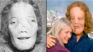 Tragic real life story of boy whose rare deformity inspired the famous film  'Mask'
