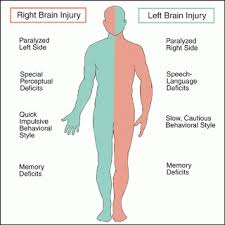 Mini Stroke Warns That Major Stroke Is Near Nursing Students Nurse Occupational Therapy