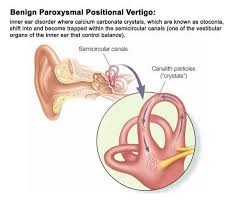 Benign paroxysmal positional vertigo (bppv) is probably the most common cause of vertigo in the united states. When To Know Your Symptoms Of Dizziness Is Vertigo Or Bppv Orange Coast Ent Head And Neck Surgery Head And Neck Surgeons