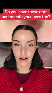 How to Remove Fordyce Spots under Eyes