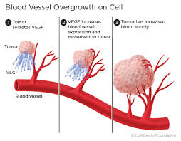 Image result for Angiogenesis