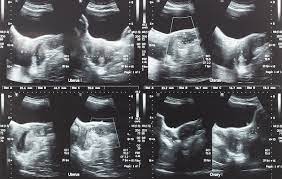 Following a diet for fibroids is an important step for natural fibroid treatment because there are many foods that contain nutrients that can help to heal the body of various diseases and conditions including fibroids. Can Uterine Fibroids Harm My Pregnancy Cancer Your Pregnancy Matters Ut Southwestern Medical Center