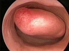 This lining grows and shrinks during different stages of the menstrual cycle. Uterine Endometrial Polyps Long Island Gynecologists The Woman S Health Pavilion
