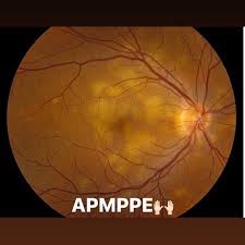 Typically, apmppe causes central vision loss in one or both eyes in young adults with the development of gray, white, or yellow, flat plaques that are predominantly located in the posterior pole at the level of. Apmppe Instagram Posts Photos And Videos Picuki Com