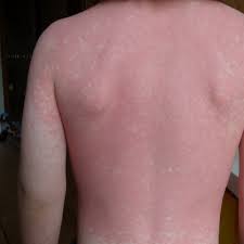 Elle est due à une bactérie appelée borrelia burgdorferi. Il Est Temps Que Je Vous Raconte Le Syndrome De Kawasaki Ou Comment Nous Avons Failli Perdre Joseph Petits Genies En Herbe