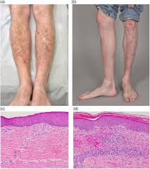 Image result for Stasis Dermatitis
