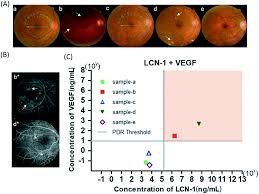 Microaneurysms appear as pinpoint, hyperfluorescent lesions in early phases of the angiogram and typically leak in the later phases of the test. Sensitive Tear Screening Of Diabetic Retinopathy With Dual Biomarkers Enabled Using A Rapid Electrokinetic Patterning Platform Lab On A Chip Rsc Publishing Doi 10 1039 C9lc00975b