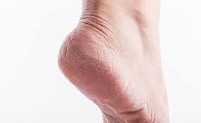 Bidang kaki sebelah bawah, biasa digunakan untuk menapak; 4 Cara Mudah Nak Elak Tumit Kaki Merekah