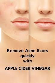 Pin On Skin Care Tips