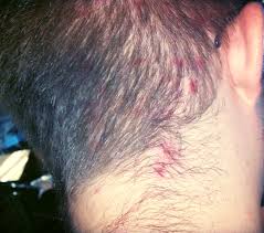 Doesn't seem to be spreading beyond the initial outbreak. Acne Have Had Breakouts On The Back Of My Neck And Scalp It Cleared Up For A Few Weeks Now It S Back Don T Know What To Do Wha Acne Breakouts Remove