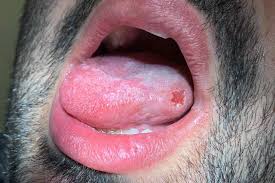Image result for mouth ulcer on tongue)