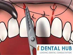 Sutures Or Stitches After Tooth Extraction Identalhub Com Tooth Extraction Aftercare Tooth Extraction Dental