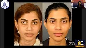 Peri ocular Aesthetic Procedures