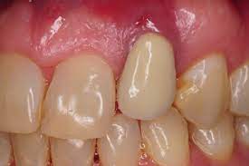 Two Common Causes For Gum Recession And Infection On Dental Implants Two Common Causes For Gum Recession And Infection On Dental Implants Kazemi Oral Surgery Facialart Com