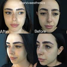 During cataract surgery, your cloudy natural lens is removed and replaced with a clear artificial lens. Foxy Eyes Cosmetic Fox Eye Lift Procedure Arviv Medical Aesthetics