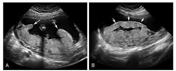 Cireumvallate Placenta A Longitudinal Image Of The Uterus During Late Second Trimester Shows A Posterior Placenta P With R Placenta Second Trimester Uterus