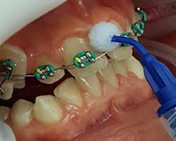 Here's how to whiten teeth with braces: Dentcoat Op Clean White Spots On Teeth After Braces Dentcoat