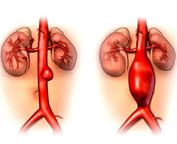 Es una dilatación en las arterias, con riesgo de ruptura y sangrado mortal, si fumaste y tienes más de 50 años, es conveniente. Enfermedades Vasculares Aneurisma De Aorta