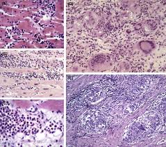 The term myocarditis refers to an inflammatory response within the myocardium that is not secondary to ischemic events or cardiac rejection in the setting of transplantation. Molecular Pathobiology Of Myocarditis Sciencedirect