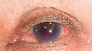 Image result for Hyphema