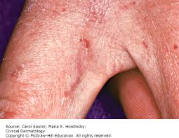 Image result for scabies in the groin area