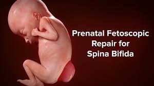 In spina bifida, the neural tube doesn't close all the. Myelomeningocele Spina Bifida Fetal Repair Fetal Care Center