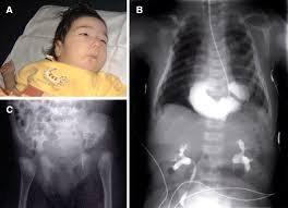 A novel non-sense mutation in the SLC2A10 gene of an arterial tortuosity  syndrome patient of Kurdish origin