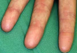 Not all hardware manufacturers ship linux drivers, and the community doesn't always pick up the slack. Adermatoglyphia The Genetic Disorder Of People Born Without Fingerprints Science Smithsonian Magazine