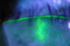 A battle between virulence factors and the immune response (a). Herpes Simplex Keratitis Guide To Diagnosis And Treatment Mivision